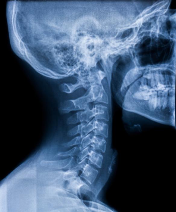 [X-ray skull from right side]
